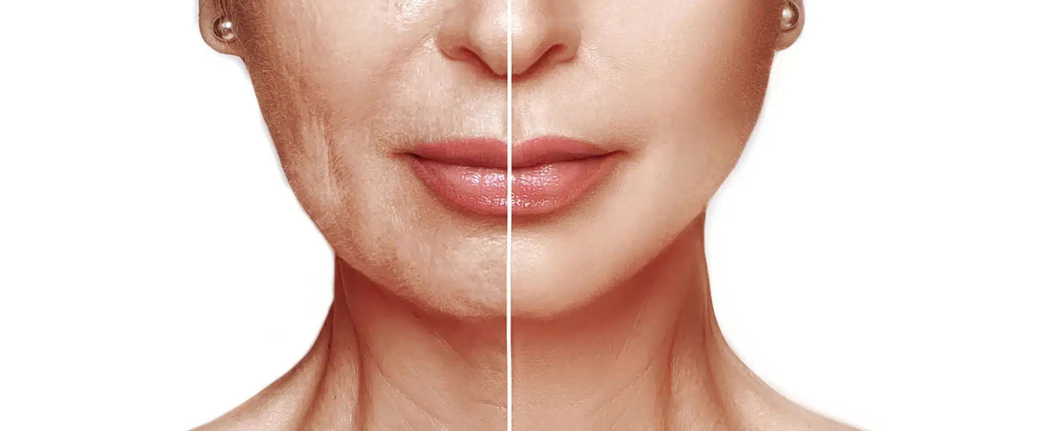 Vamprlift_vorher_nachher_sw